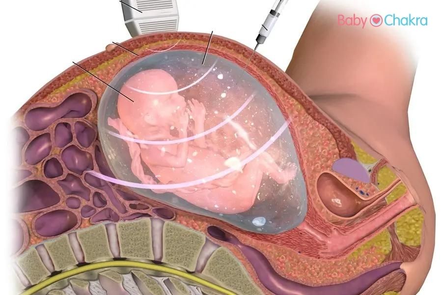 Amniocentesis Test: एमनियोसेंटेसिस टेस्ट क्या है, प्रक्रिया, परिणाम