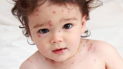 All You Need To Know About Chicken Pox