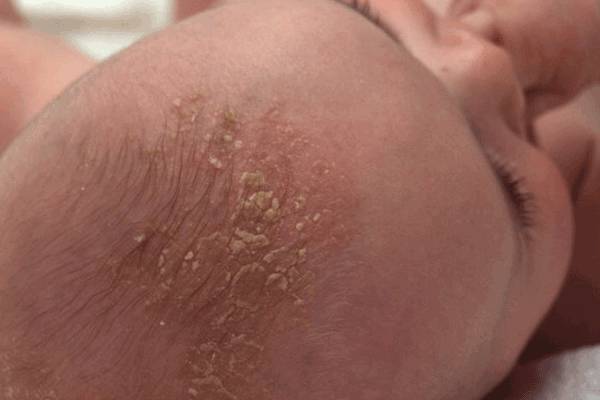 Interview with Dr. Subash Rao: All you need to know about Cradle cap