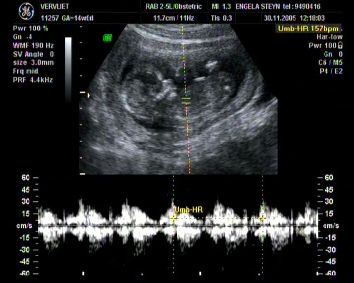 Fetal Heart Rate: An Overview