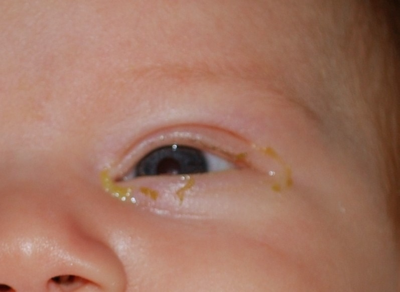 Blocked Tear Duct In Babies: Symptoms, Causes And Treatment