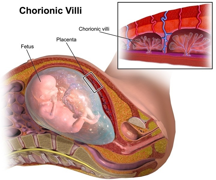 क्या है गर्भावस्था के दौरान कोरियोनिक विलस सैम्पलिंग (सीवीएस) परीक्षण?