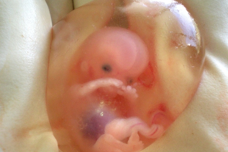 गर्भ में मेकोनियम के क्या हैं परिणाम?