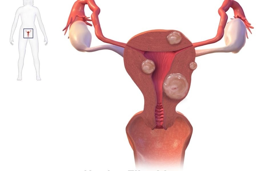 गर्भावस्था के दौरान फाइब्रॉइड की जटिलताओं को जानते हैं आप ?