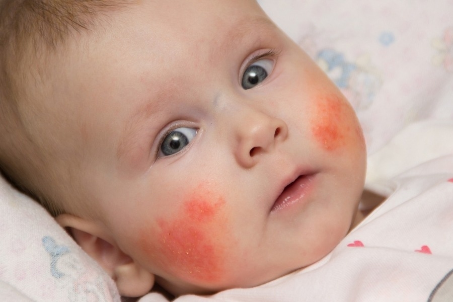 क्या आप शिशुओं में खाद्य एलर्जी के बारे में जानते हैं ?