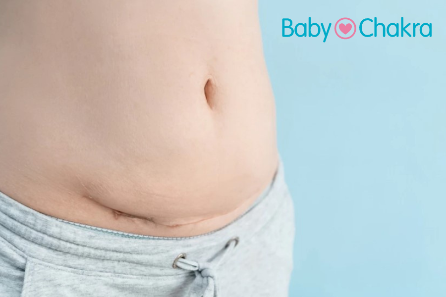 C-section Scars: Types Of Incisions, Healing, And Treatment