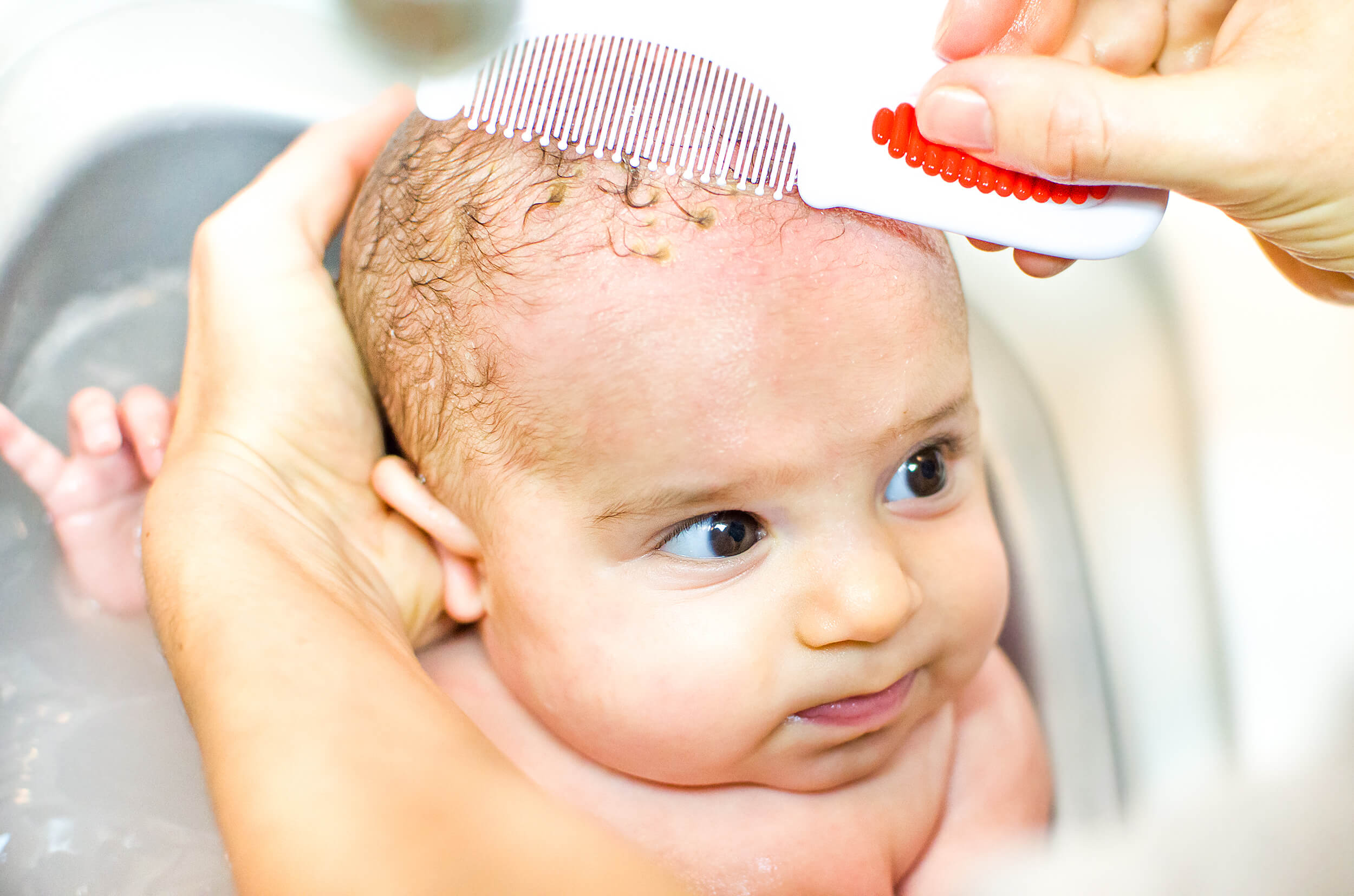 causes of cradle cap and how to treat it