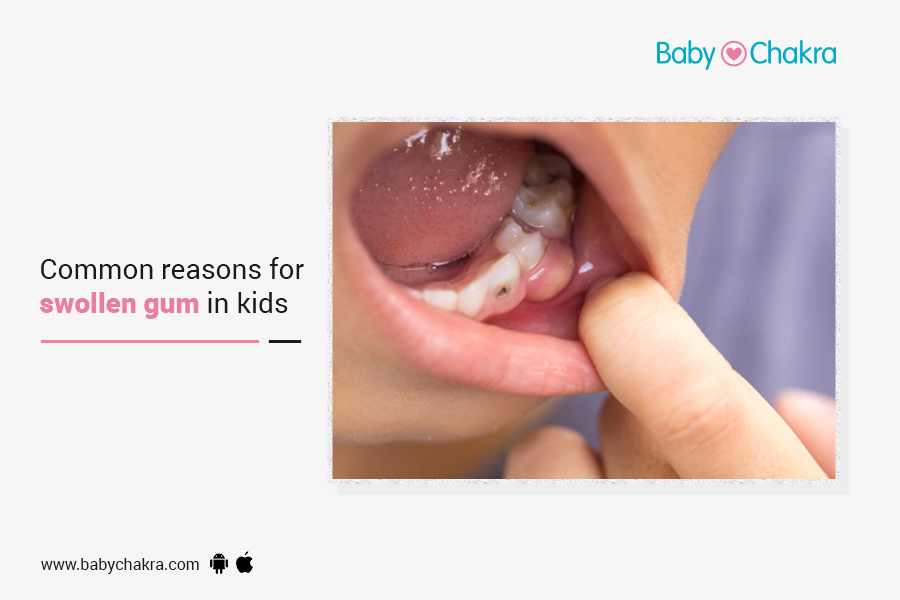 Common Reasons For Swollen Gum In Kids