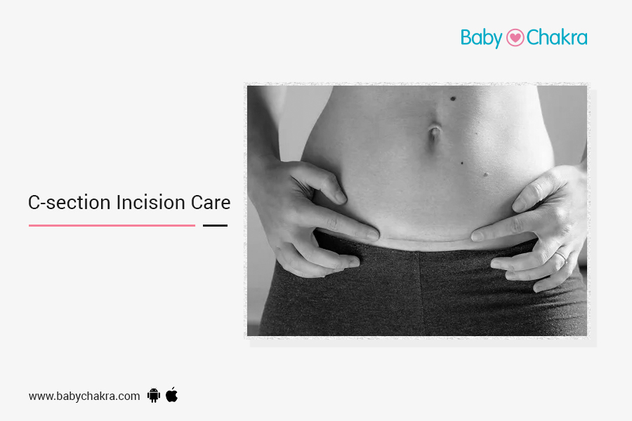 C-section Incision Care