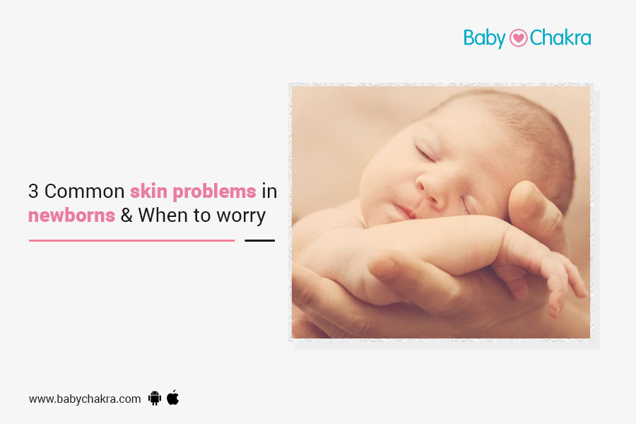 3 Common Skin Problems In Newborns &#038; When To Worry