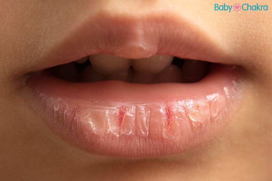 लिप लिकर डर्मेटाइटिस (Lip Licker&#8217;s Dermatitis) के कारण, लक्षण और उपचार