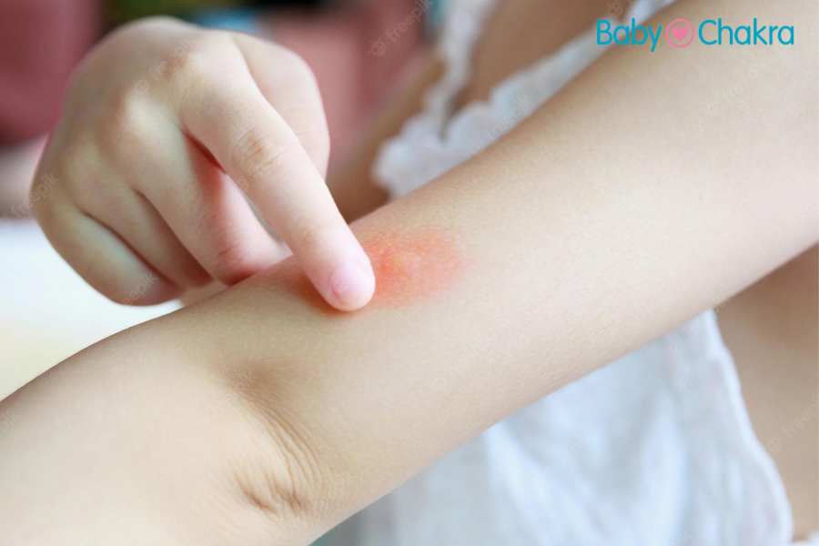 7 Ways To Cure Mosquito Bites In Toddlers