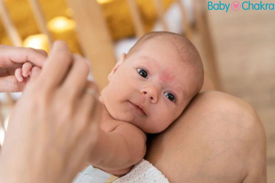 5 Myths And Facts About Baby Eczema