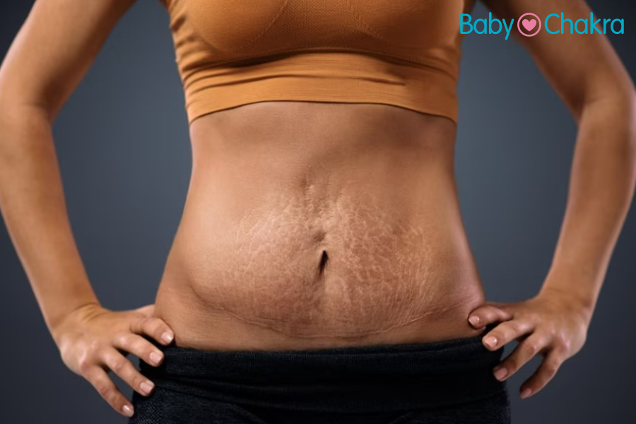 10 Helpful Tips To Tighten Belly Skin After Pregnancy